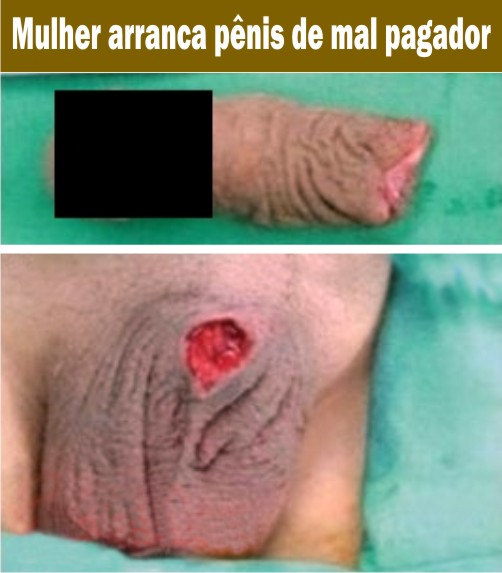 Aumento no membro do modo cirúrgico preço