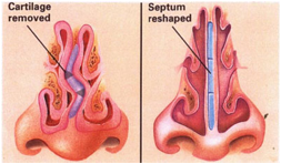 Surgery to Fix a Deviated Septum: Explanation of surgery