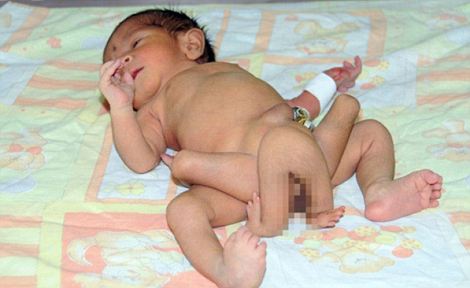 巴基斯坦母親　生下6條腿男嬰1