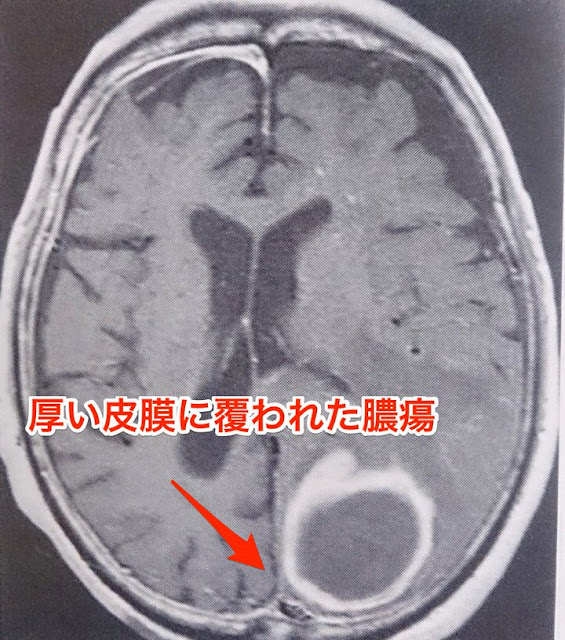 脳膿瘍のMRI画像