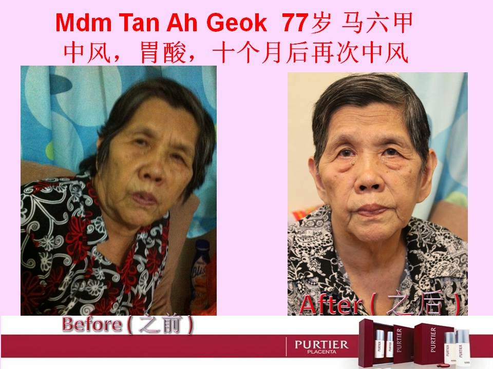 MDM TAN AH GEOK (77) MALACCA - STROKE, GASTRIC, 10 MONTHS LATER 2ND STROKE