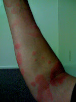 Topical steroids for urticaria