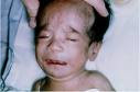 Fetal Alcohol Syndrome