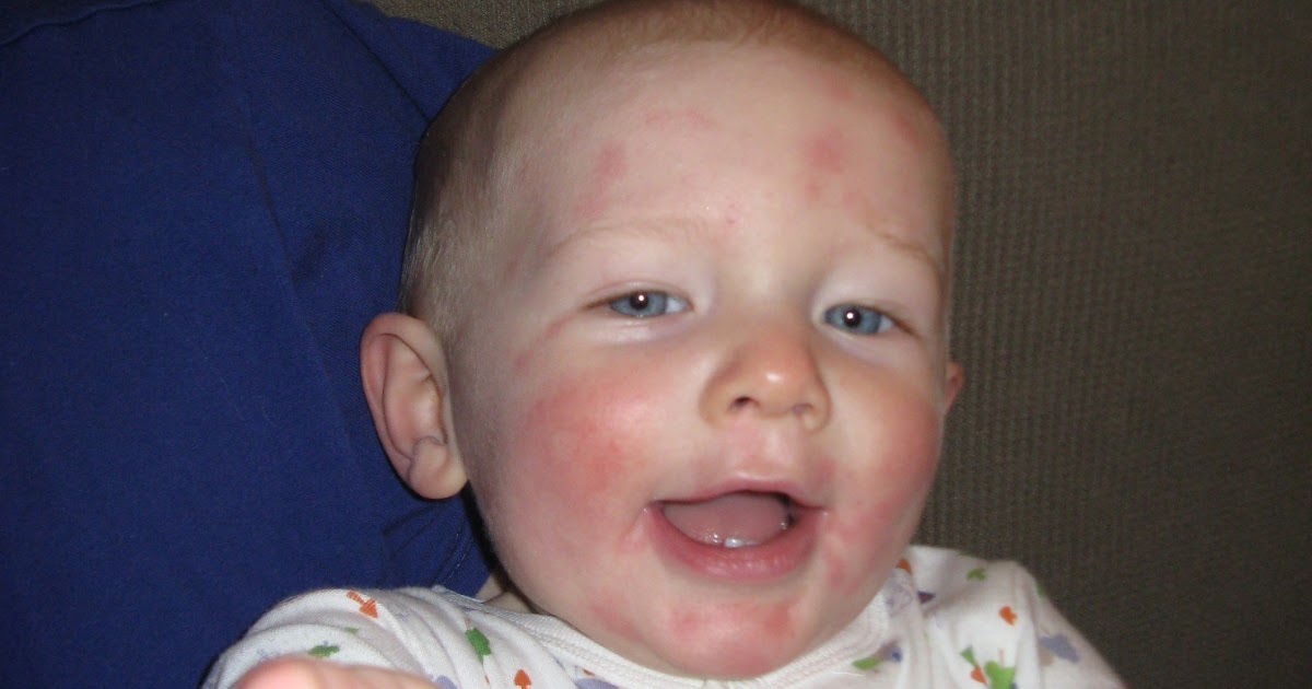 Peanut Butter Allergic Reaction Smell at Matthew Grimes blog