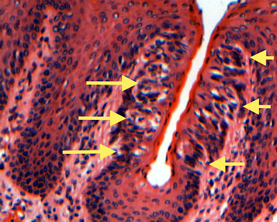 asin all these cases the inflamed taste bud. asin all these cases the