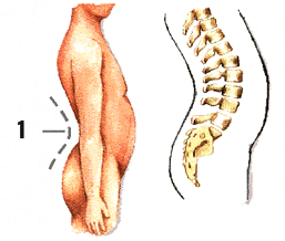 Hiperlordosis Lumbar Hiperlordosis Lumbar