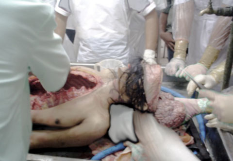 [michael_jackson_autopsy_photo.jpg]