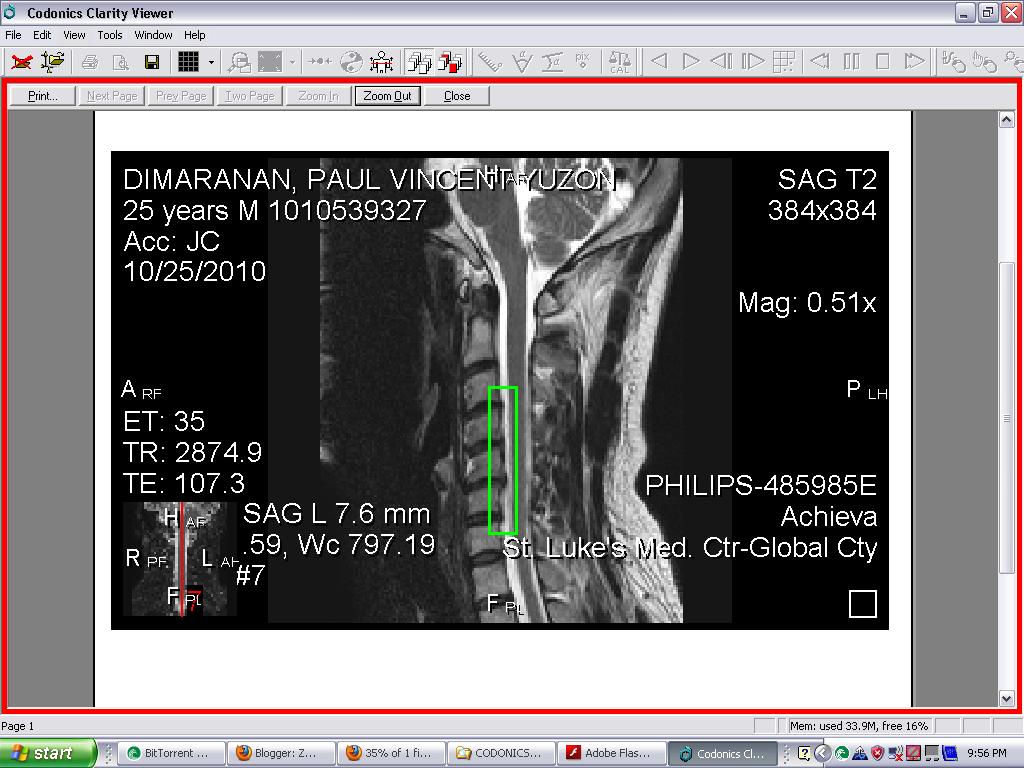 Slipped Discs In Neck Causes