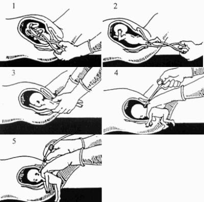 Comment se passe un avortement par aspiration