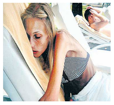 Anorexia Lanugo Pictures