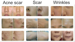 acne scar, pore , uneven skintone, cosmetic surgery, ect