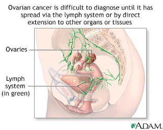 Ovarian Cancer