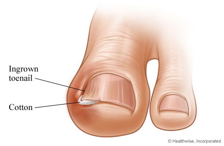 Ingrown toenail remedy cotton. Most of the over the counter type treatments