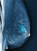 [breastcancer1.jpg]