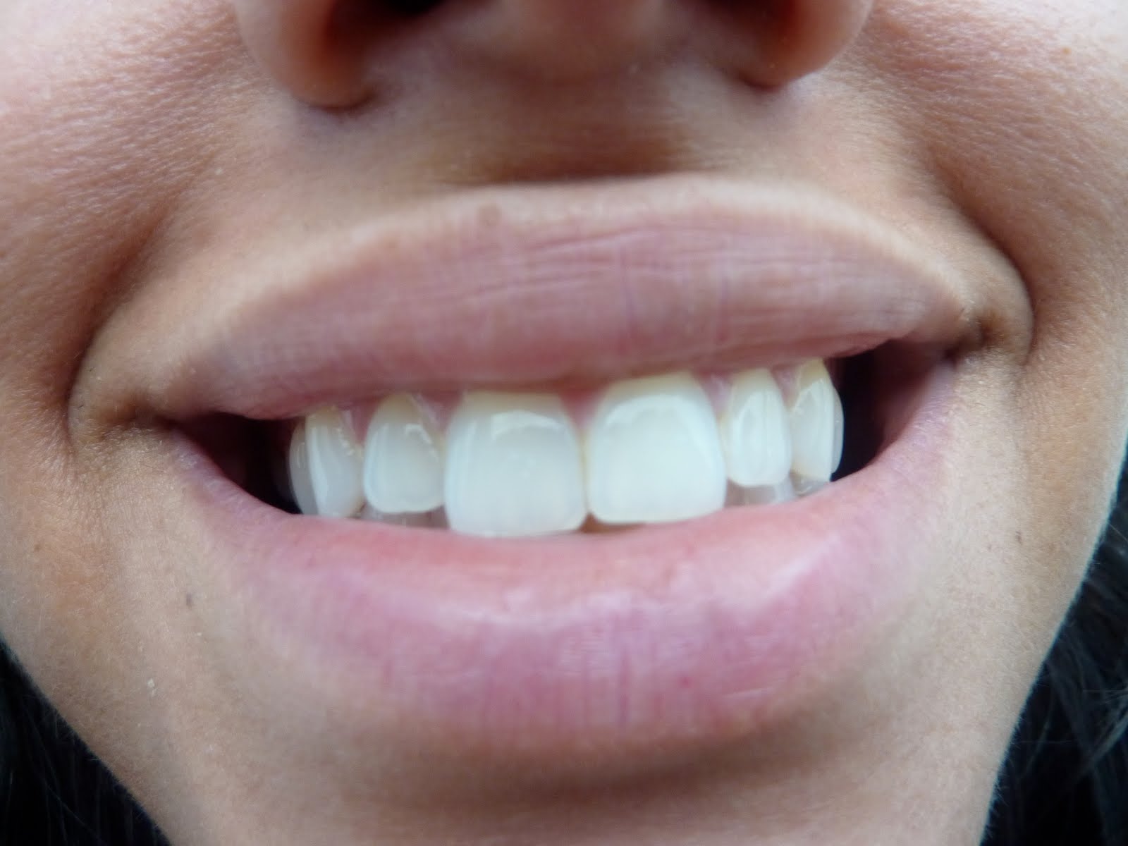 Crest whitestrips before and after photos : Teeth bleaching gel side 