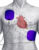 Portable Defibrillator Reviews & Cost: Portable Defibrillator History Portable Defibrillator Reviews & Cost: Portable Defibrillator History