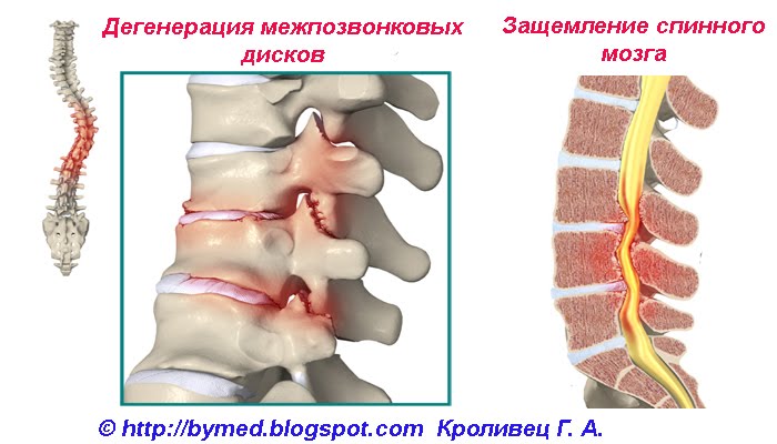 Последствия сколиоза
