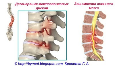 Последствия сколиоза
