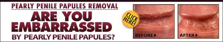 Penile Papules Removal Banner