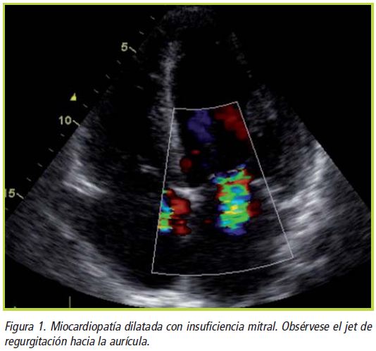 Insuficiencia Mitral