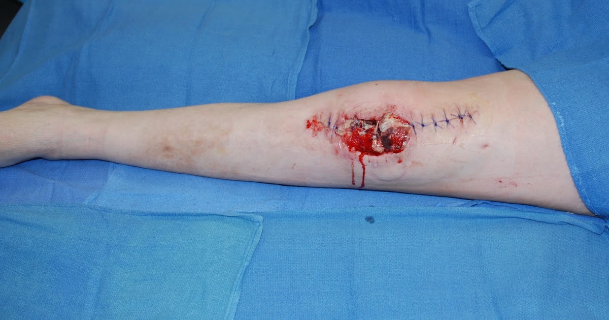 Flap Surgery: Autologous Tissue, Wounds, Microvascular Free Flaps