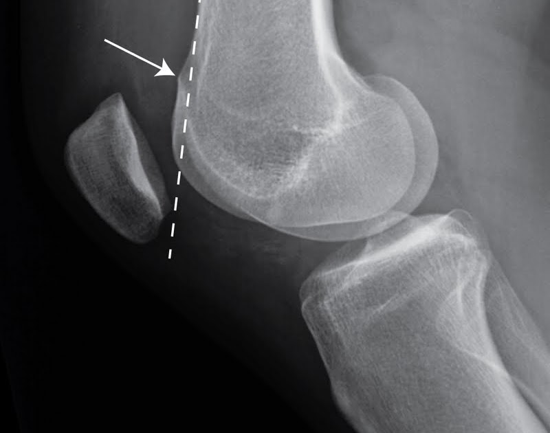 Roentgen Ray Reader: Femoral Trochlear Dysplasia