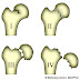 Garden Fracture Classification