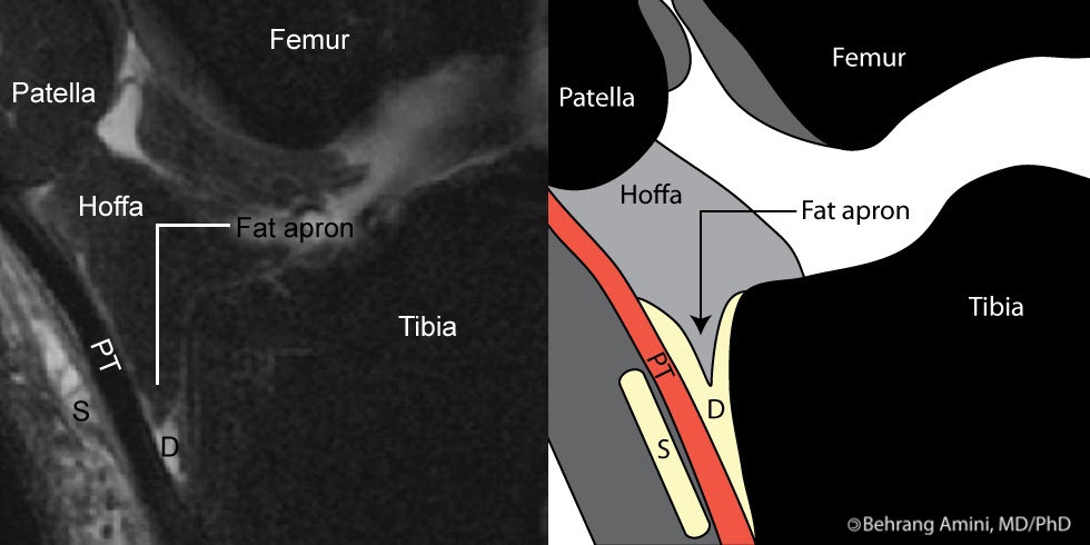 Roentgen Ray Reader: Deep Infrapatellar Bursa