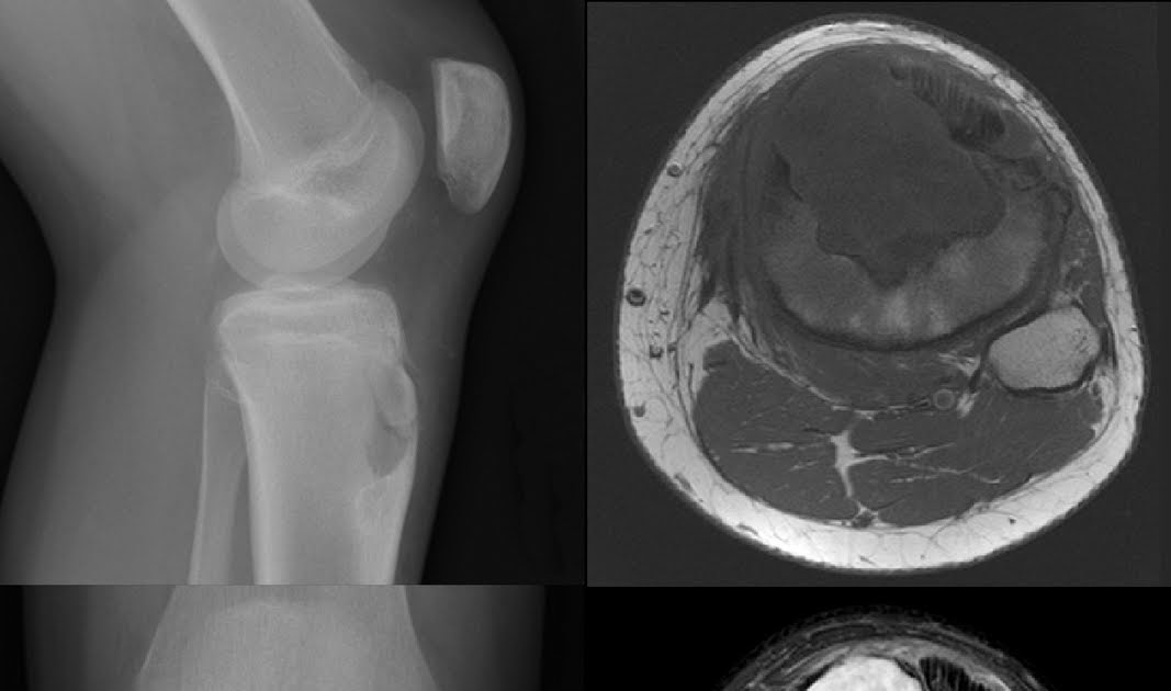 Roentgen Ray Reader: Chondromyxoid Fibroma