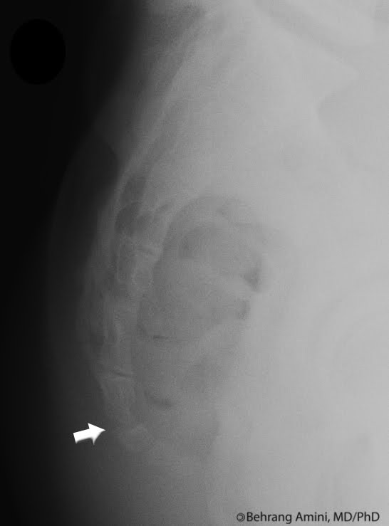 Roentgen Ray Reader: Anterior Angulation of the Coccyx