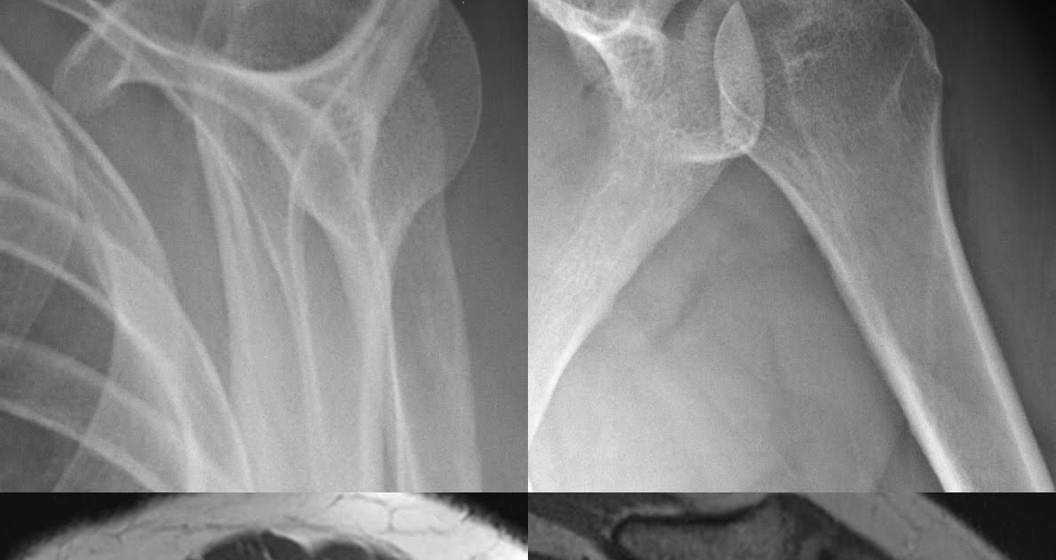 Roentgen Ray Reader Calcium Hydroxyapatite Deposition Disease Shoulder
