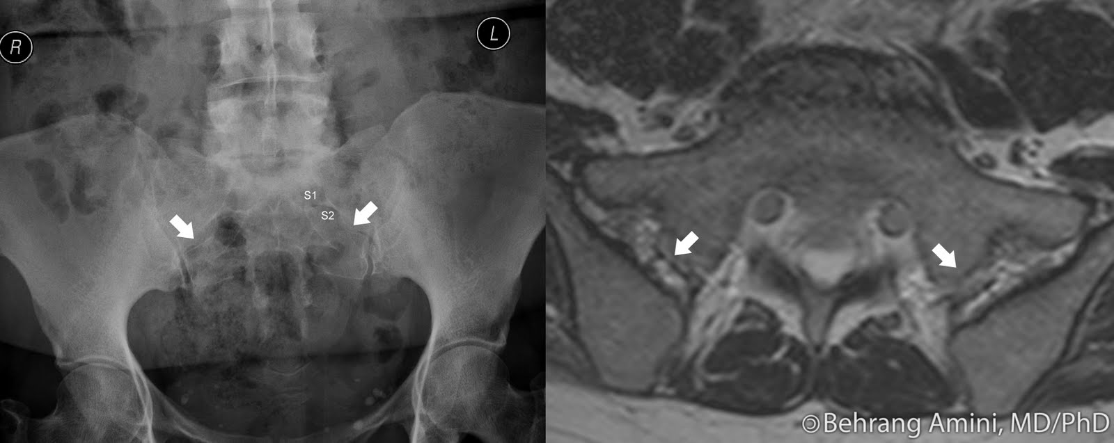 Roentgen Ray Reader Accessory Sacroiliac Joint