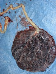 accessory lobe placenta