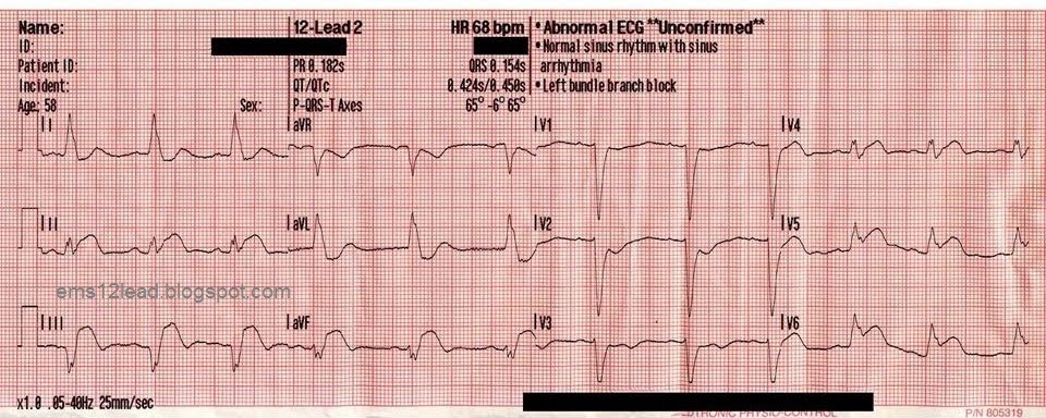 View V4R Ekg Pictures