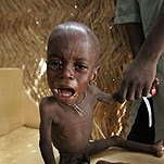 baby suffering from AIDS