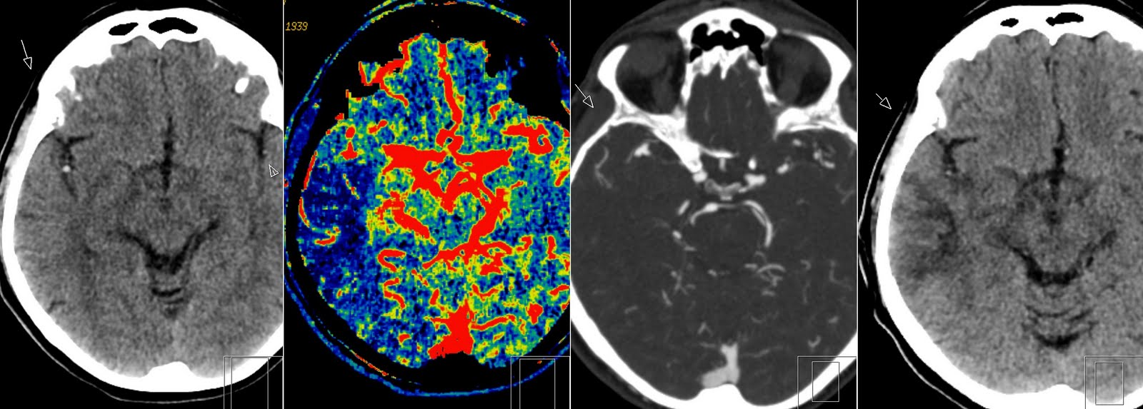 Cavum Velum Interpositum Mri