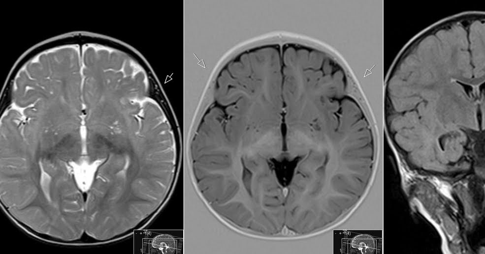 Radiology MRI Perivascular Spaces