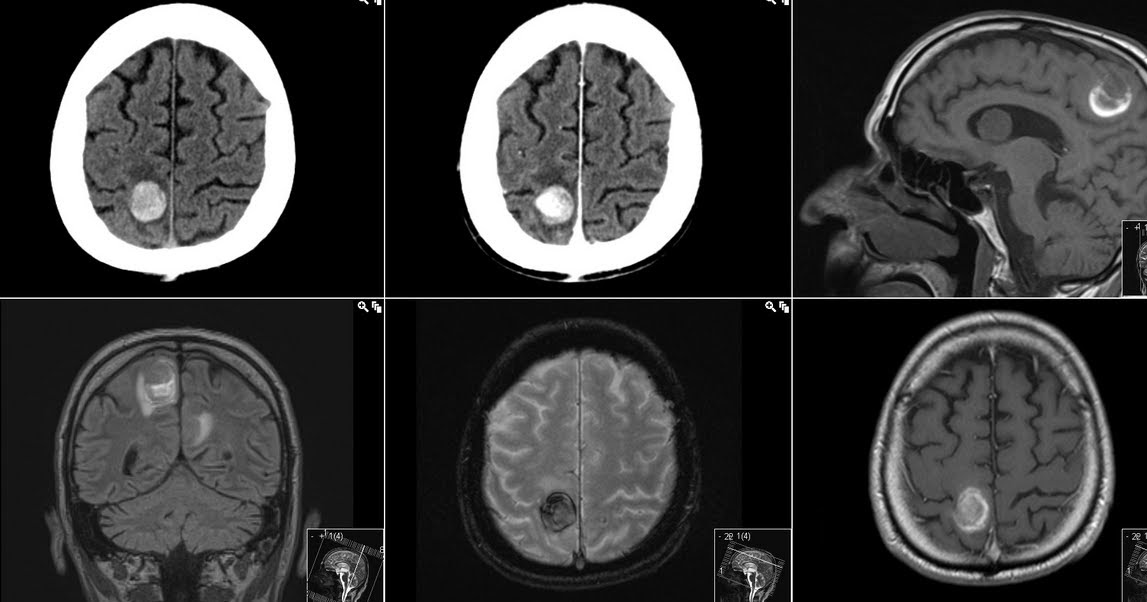 Radiology MRI Hemorrhagic Brain Metastases