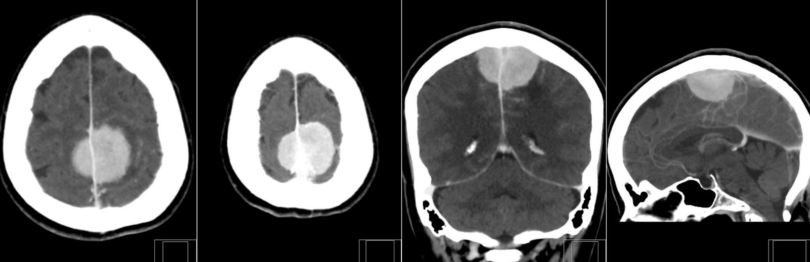 Ct+scan+of+brain+cancer