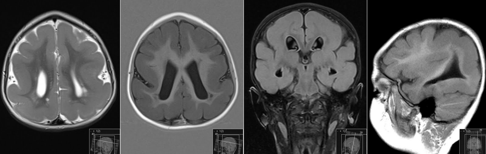 Cavum Velum Interpositum Mri