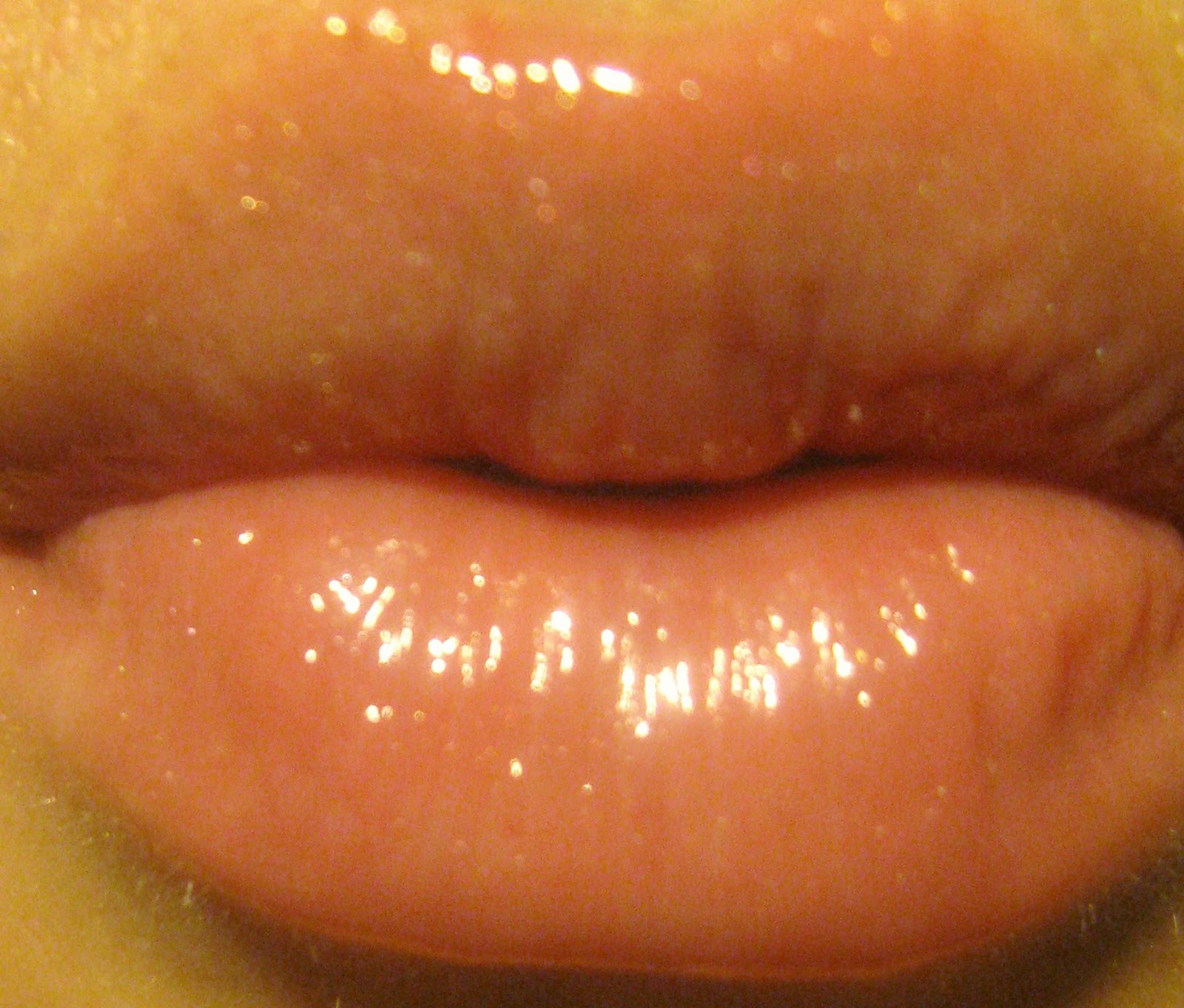 List 96+ Pictures Acne On Lips Pictures Excellent