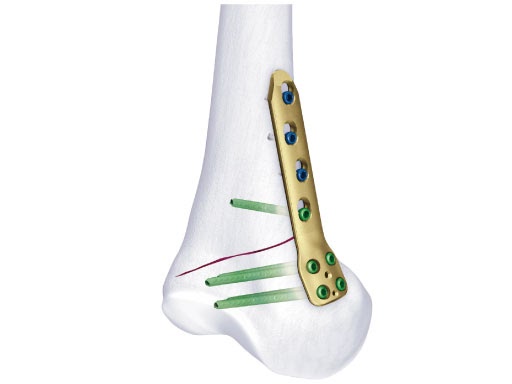 ORTHOPAEDICS: TomoFix Medial Distal Femur (MDF)