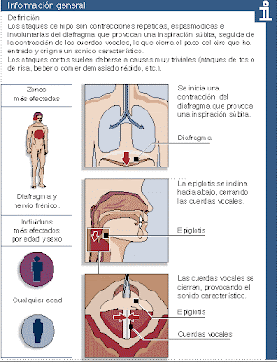 Todo lo que se necesita saber sobre El Hipo Todo lo que se necesita saber sobre El Hipo