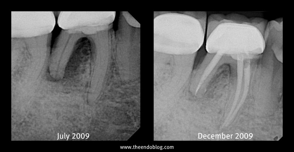 The Endo Blog Is That a Root Fracture?