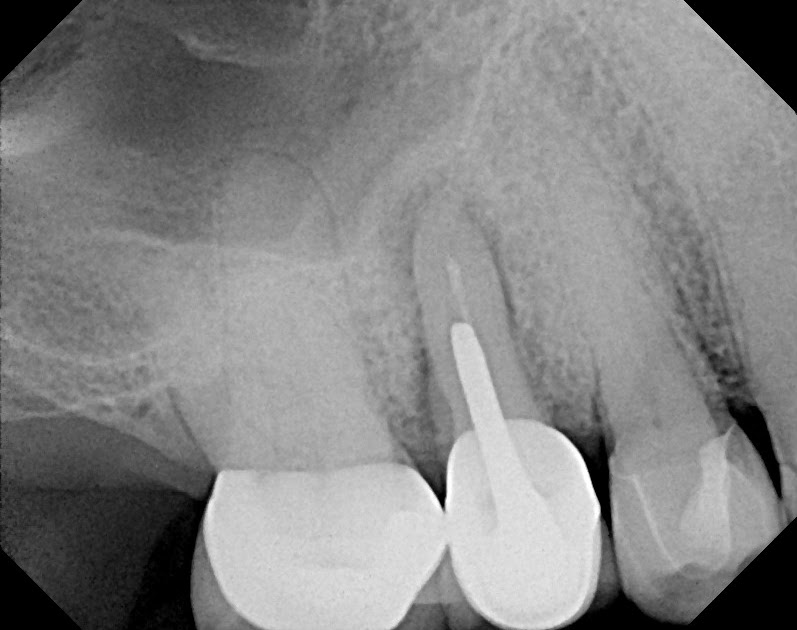 The Endo Blog Diagnosing Root Fractures continued