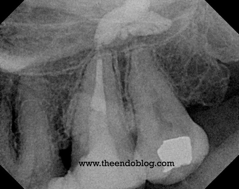 The Endo Blog Resorption of Calcium Hydroxide Paste
