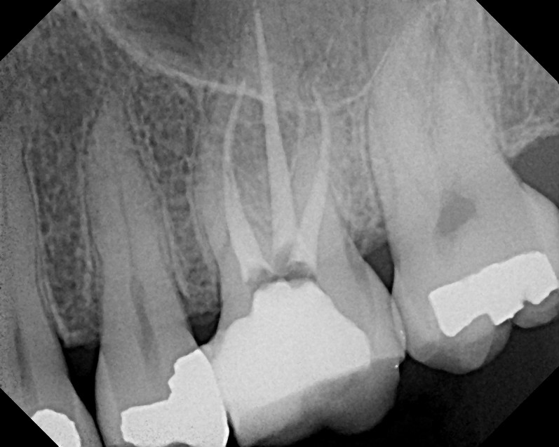 L2 Adrenaline 1 99 Cracked Tooth
