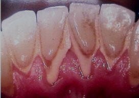 What Is DENTAL PLAQUE