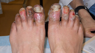 Frostbitten Toes Pictures