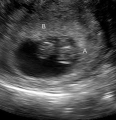 First Ultrasound Picture